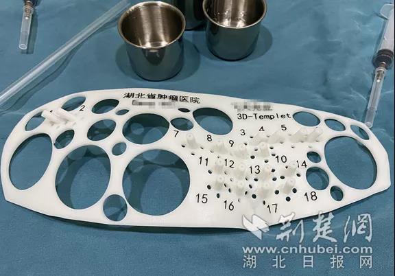 醫(yī)生用3D打印模板為患者定好18個(gè)點(diǎn)位精準(zhǔn)植入粒子
