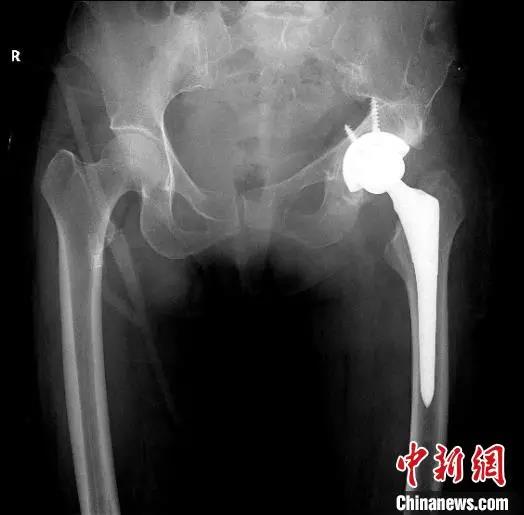 3D打印技術(shù)輔助人工關(guān)節(jié)置換手術(shù) 解患者20余年疼痛