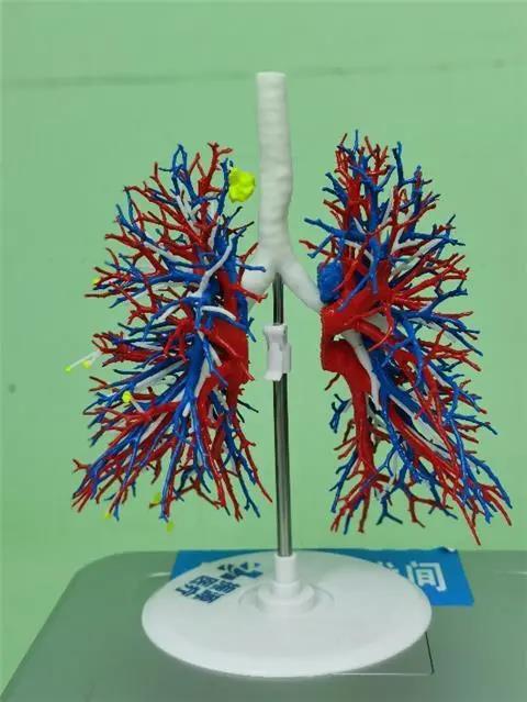 貴州省首例3D打印模型下的精準(zhǔn)肺段切除手術(shù)在省醫(yī)完成