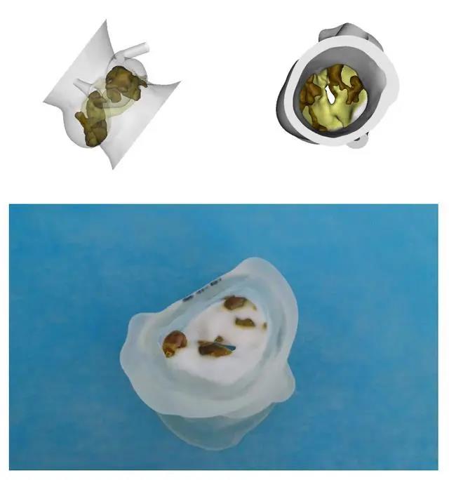 江西首例！3D打印技術(shù)換心臟瓣膜 更加精準(zhǔn)