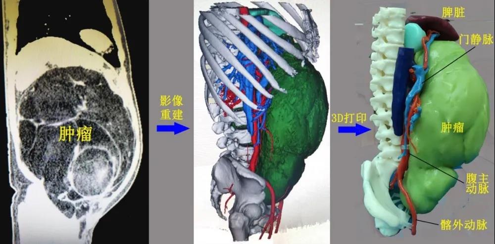 3D打印導航 精準拆除腹部16斤“巨彈”