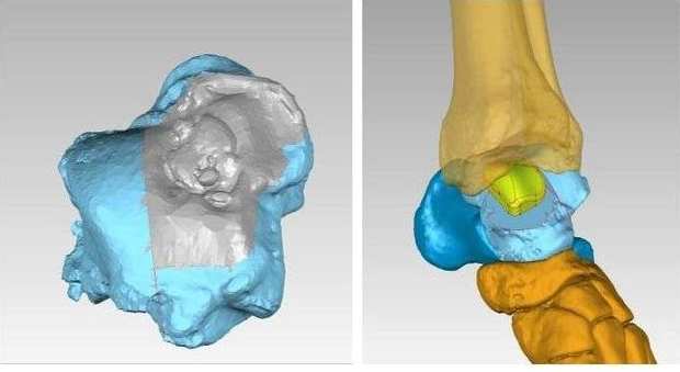 齊魯醫院手足外科成功完成3D打印距骨半髁置換手術
