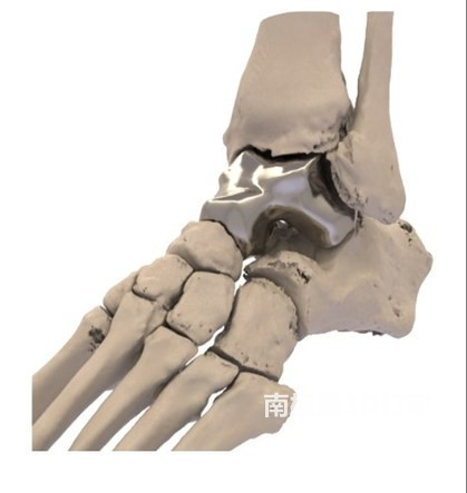 首個3D打印距骨植入物獲得FDA批準，Additive Orthopaedics公司