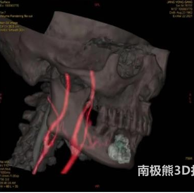 青島城陽區人民醫院運用3D打印為晚期舌癌患者完成頸動脈造影術加化療栓塞術