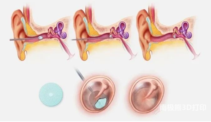 哈佛科學(xué)家研發(fā)的3D打印鼓膜修復(fù)貼片已經(jīng)進入商業(yè)生產(chǎn)