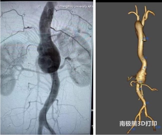 “3D打印”技術助力治療高難度主動脈瘤