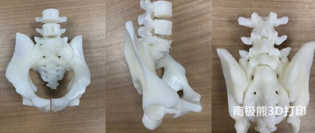 3D打印技術(shù)助力脊柱手術(shù)，讓患者重獲新生
